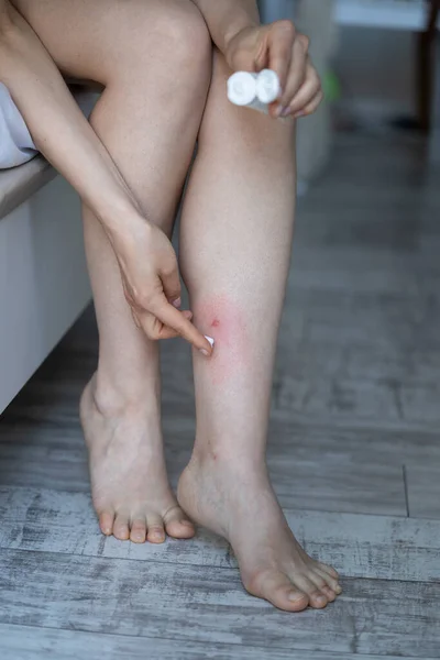 Mujer Sentada Cama Casa Aplicando Crema Bálsamo Pierna Hinchada Piel — Foto de Stock