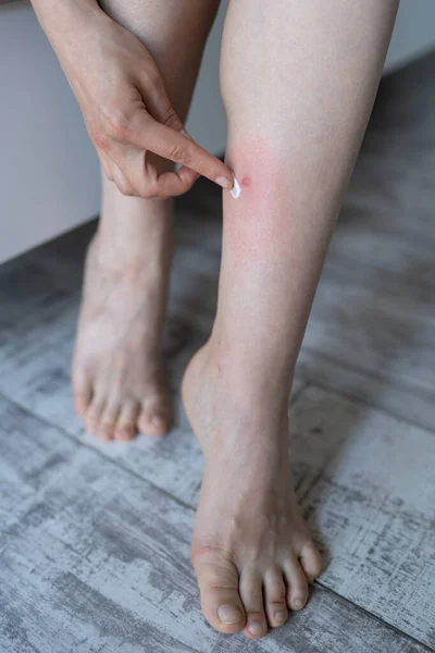 Female Shows Bite Flea Blood Sucking Insect Leg Sleep Home — Stock Photo, Image