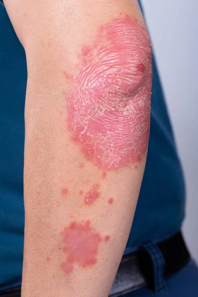 Unrecognizable man feel bad on skin disease called psoriasis. Large red, inflamed, rash on elbows. Joints affected by psoriatic arthritis, suffering from autoimmune incurable dermatological, close up