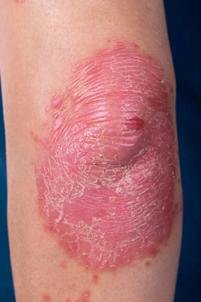 Unrecognizable man feel bad on skin disease called psoriasis. Large red, inflamed, rash on elbows. Joints affected by psoriatic arthritis, suffering from autoimmune incurable dermatological, close up