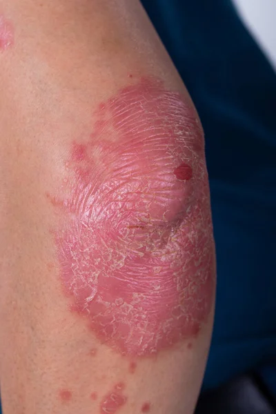 Unrecognizable man feel bad on skin disease called psoriasis. Large red, inflamed, rash on elbows. Joints affected by psoriatic arthritis, suffering from autoimmune incurable dermatological, close up