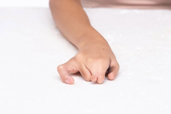 Рука Людини Обмеженими Можливостями Пальців Дитинства Великого Пальця Нігтів Білому — стокове фото