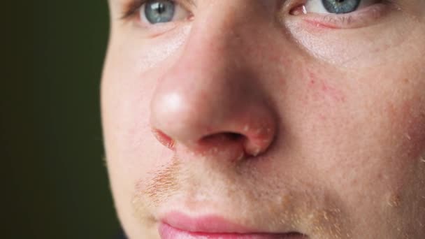 Dolor de nariz después de un primer plano de secreción nasal. piel agrietada en la nariz. dolor en la piel de la cara. cara masculina primer plano — Vídeo de stock
