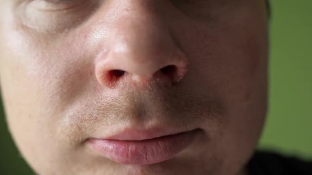 Un naso dolorante dopo un primo piano naso che cola. pelle screpolata sul naso. pelle dolente sul viso. volto maschile primo piano — Video Stock