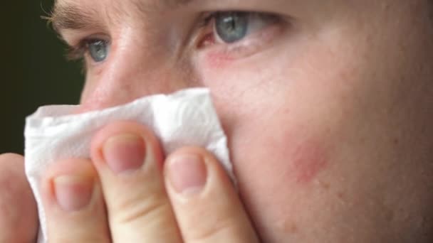 The man blows his nose in a handkerchief. a sore nose after a runny nose close-up. cracked skin on the nose. sore skin on the face. male face close-up — 图库视频影像