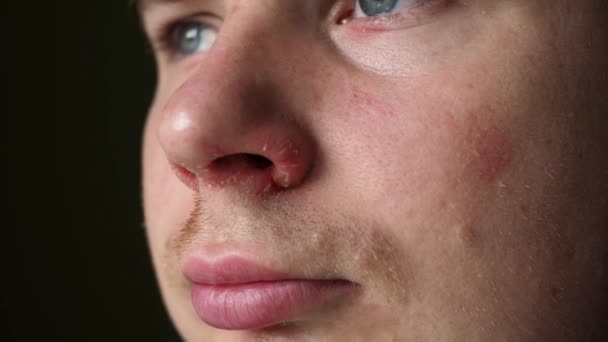 Eine wunde Nase nach einer laufenden Nase aus nächster Nähe. Risse auf der Nase. Wunde Haut im Gesicht. männliche Nahaufnahme — Stockvideo