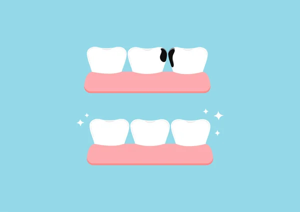 Teeth before and after proximal decay in gym dental icon set isolated on blue background. — Stock Vector