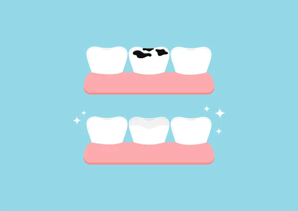 Zęby przed i po wielokrotnej próchnicy w siłowni zestaw ikon dentystycznych izolowane. — Wektor stockowy