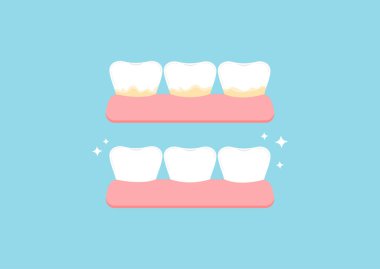 Beyaz dişli ve ikon setinden önce sarı tartar plakalı. Diş lekesi tedavisi, temizleme ve beyazlatma konsepti. Düz çizgi film vektör çizimi. Diş hijyeni..