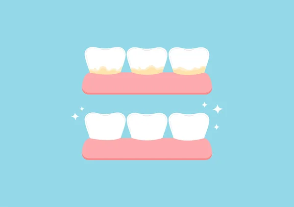 白い歯とアイコンが設定された後の前に黄色のタルタルプラーク 歯茎の汚れの治療で歯 除去し クリーニング ホワイトニングの概念 フラット漫画のベクトルイラスト 歯科衛生 — ストックベクタ