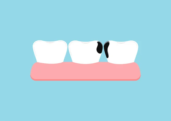 Tanden met proximale verval in de sportschool tandheelkundige pictogram geïsoleerd op blauwe achtergrond. Vectorbeelden
