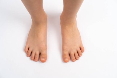 Beyaz arka planda çocuk ayakları, düz taban çocuk önleme kavramı, ayak valgus