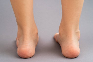 Gri arka plan görünümlü çocuklar, düz taban çocuk önleme kavramı, ayak valgus