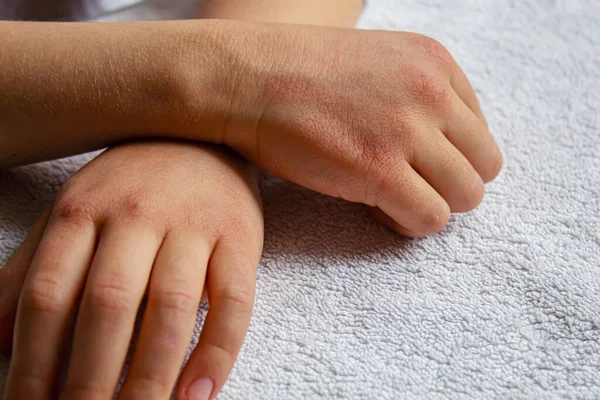Red Spots Skin Child Hands Children Allergy Selective Focus Nature — Stock Photo, Image