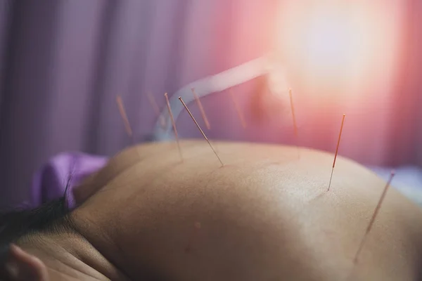 Asiatisk Kvinna Slappnar Från Akupunktur Förfarande Akupunktör Doong Akupunktur Mycket — Stockfoto
