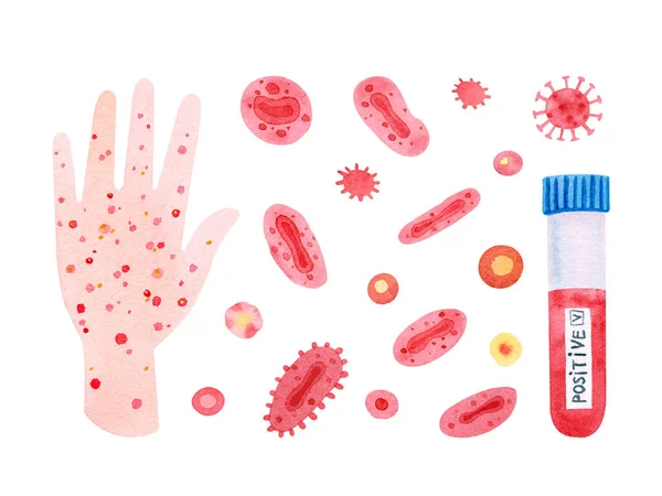 Illustration Monkeypox Virus Virions Sick Human Hand Bumps Skin Isolated — Stockfoto