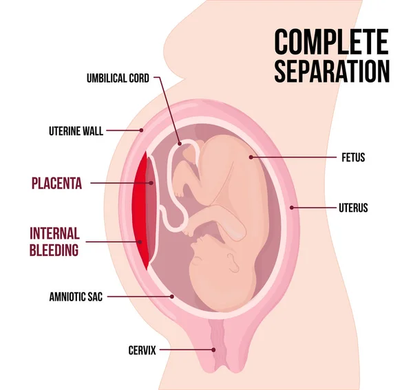 Enfant dans l'utérus. Séparation complète du placenta, rupture placentaire. Hémorragie interne. Complication dangereuse de la grossesse, risque de fausse couche. — Image vectorielle