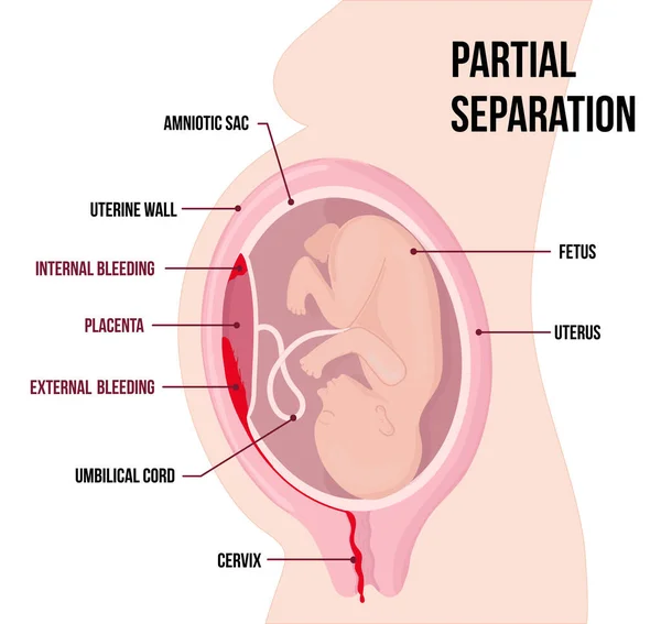 Kind in de baarmoeder. Gedeeltelijke scheiding van placenta, placenta abruptie. Vaginale en inwendige bloeding. — Stockvector