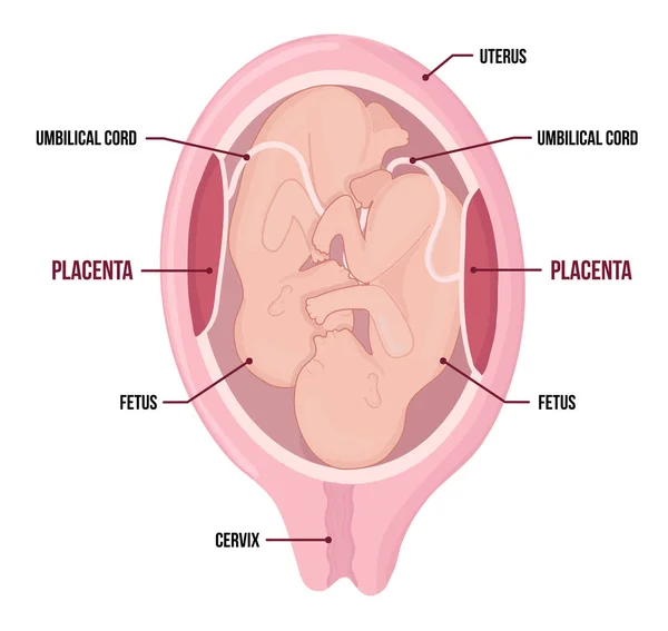 Δίδυμα στη μήτρα. μονοζυγωτική εγκυμοσύνη με δύο childeren μέσα. — Διανυσματικό Αρχείο