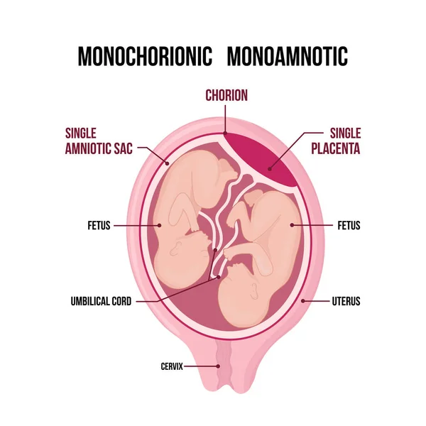 Monochorionale monoamnionale tweeling medisch diagram geïsoleerd op witte achtergrond. — Stockvector