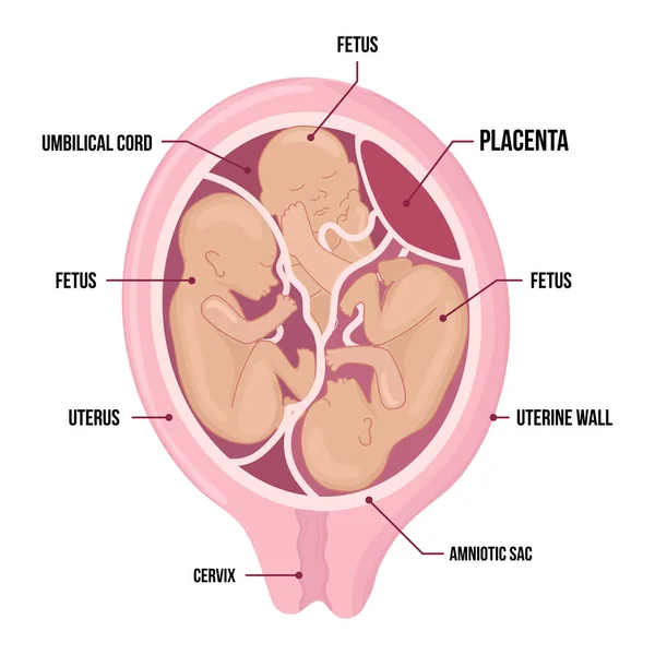 Τρίδυμα στη μήτρα. τρία έμβρυα στη μήτρα. Πολλαπλή εγκυμοσύνη. παράγοντας κινδύνου. Τρεις ομφάλιοι λώροι. — Διανυσματικό Αρχείο