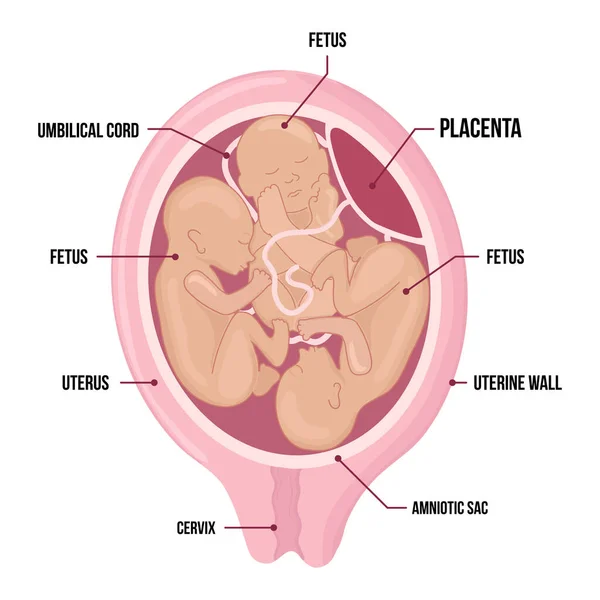 자궁의 세쌍둥이. 자궁 속에 세 명의 태아가 있습니다. 다발성 임신이요. 위험 요소. 세 개의 탯줄. — 스톡 벡터