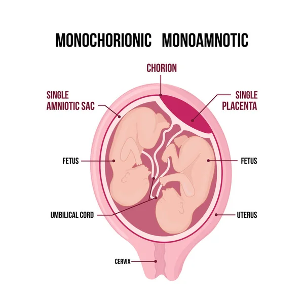 Monochorionale monoamnionale tweeling medisch diagram geïsoleerd op witte achtergrond. — Stockvector