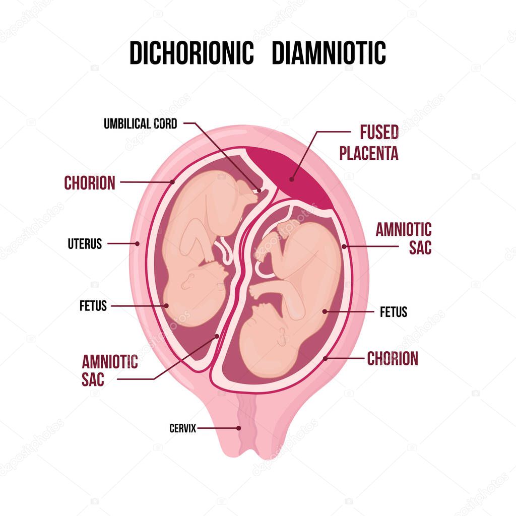 Dichorionic diamniotic twins with fused placenta
