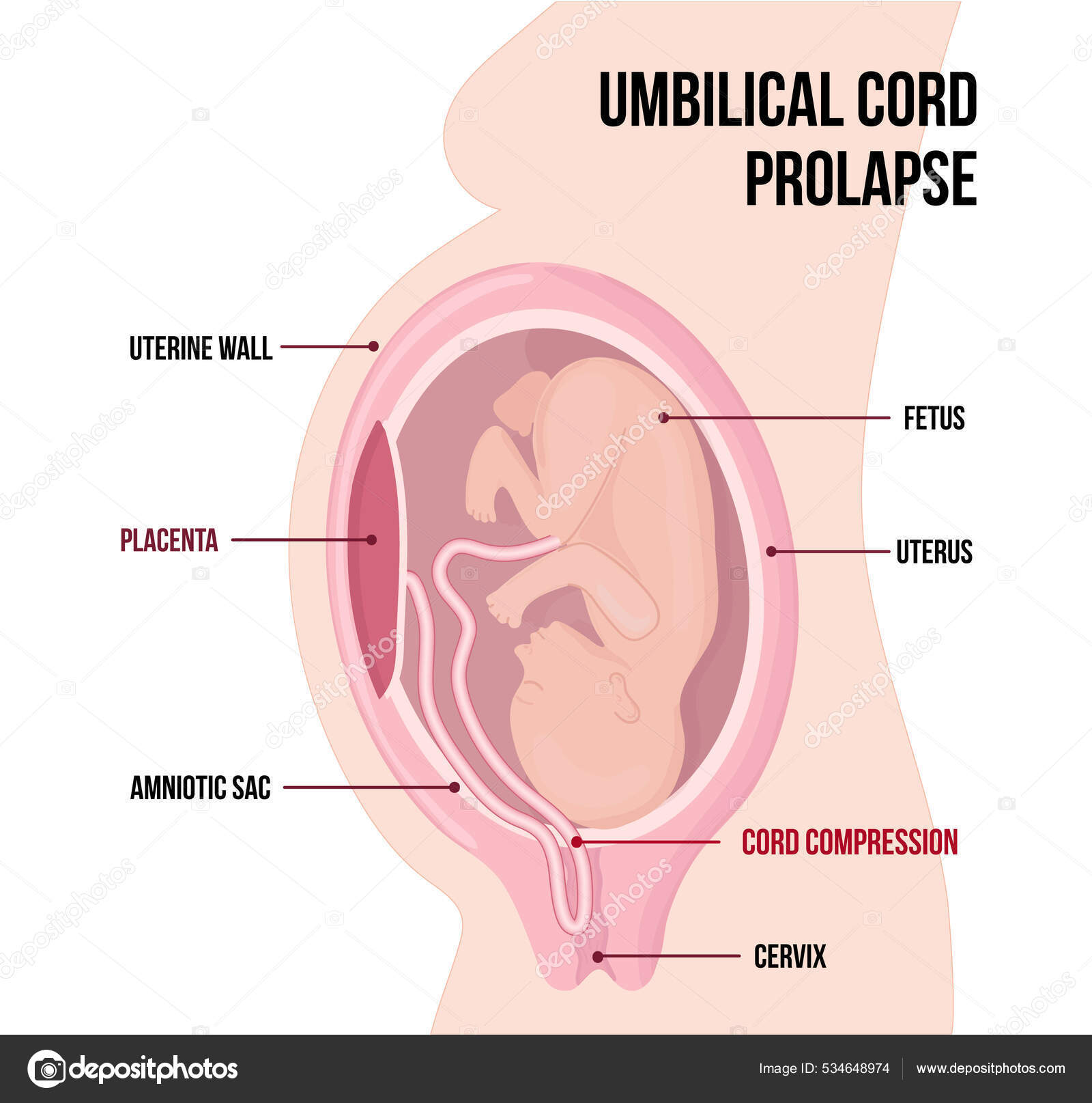 Cordão umbilical prolapso, diagrama vetorial médico com termos Vetor de  stock de ©Betty1994 534648974, image size:1600x1615
