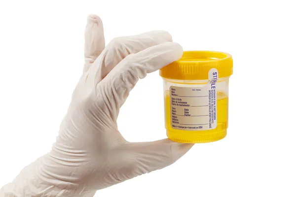 Urine Sample With Glove — Stock Photo, Image