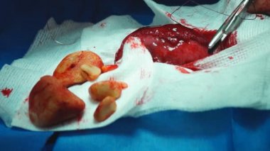 Veteriner birkaç büyük mesane taşları bir köpek olarak kaldırma.