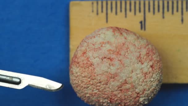 Veterinarian removing extremely large Bladder stone in a dog — Stock Video