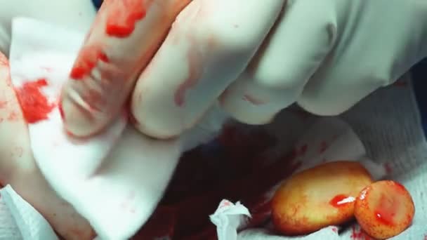 Veterinarian removing several large Bladder stones in a dog. — Stock Video