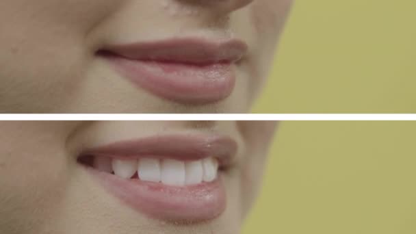 Profesyonel Diş Beyazlatma Daha Önce Çirkin Dağınık Olan Beyaz Gülüşünün — Stok video
