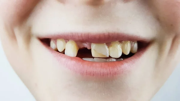 Niño Sin Diente Delantero Está Sonriendo Examen Dental Tratamiento Dental —  Fotos de Stock