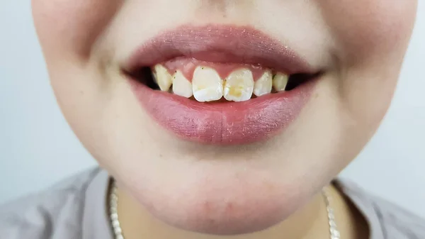 Uma Criança Com Dentes Irregulares Cor Manchas Sorrisos Exame Dentário Imagens Royalty-Free