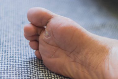 Papillomavirüs bulaşmış bir ayağın yakın plan fotoğrafı.