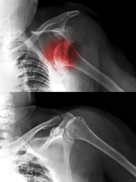 X 射线图像的肩关节脱位 免版税图库照片