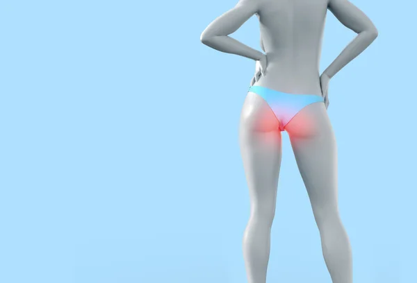 3D描述女性高韧带痔疮患者的体形 — 图库照片