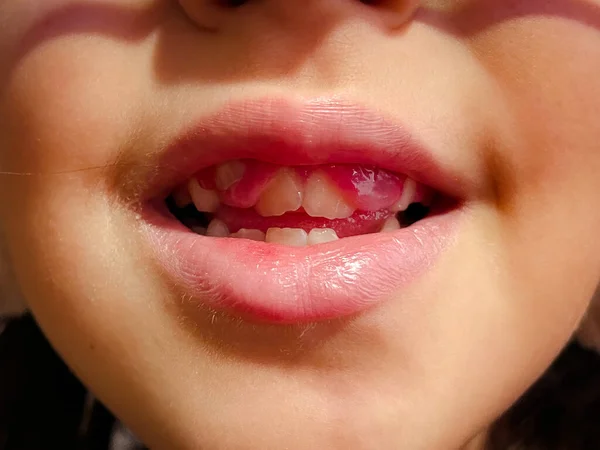 Gum Disease Children Gingival Lowering Due Orthodontic Appliance Use Photo — ストック写真