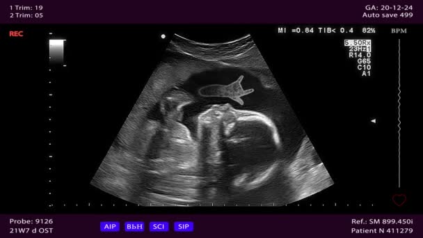 Unborn baby does Dios two-finger gesture in the womb. — Stock Video