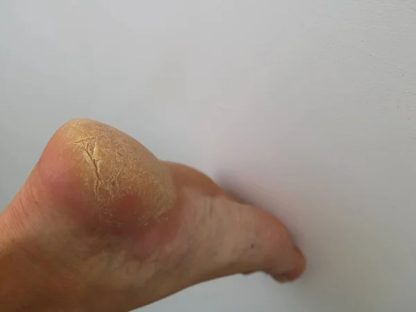 Треснувшая Сухая Кожа Пятке Белом Фоне Заболевания Проблемы Ног Иммунные — стоковое фото