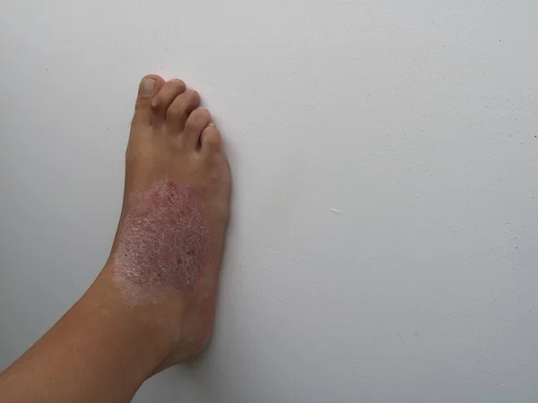 白种人的腿 皮肤上有一个大的银屑病斑 背景浅 免疫疾病及其皮肤表现 皮肤上湿疹的特写 — 图库照片