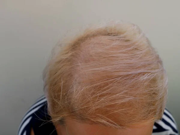 Close Van Een Kale Witte Vrouw Hoofd Dunner Geverfd Blond — Stockfoto