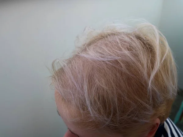 the head of a blonde with short thin hair as an example of a woman\'s baldness due to stress or illness, hair loss on a woman\'s head using a real example of a patient
