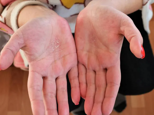 女性手掌上的特写湿疹 人类手上的皮肤问题和疾病 女性手掌上的皮肤片状干枯 身体荷尔蒙平衡的紊乱和后果 — 图库照片