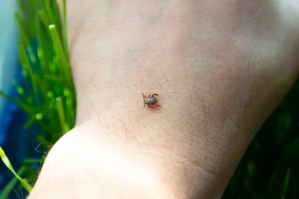 Infected dangerous biting tick on human skin. The tick is a carrier of infections and viruses. Ixodus ricinus. Parasitic mite.