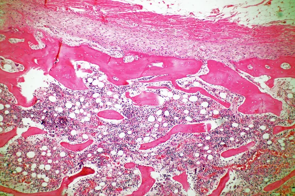 아데노이드 낭포성 마이크로 범위는 부위에 종류의 종양은 매크로 40X 미생물학 — 스톡 사진