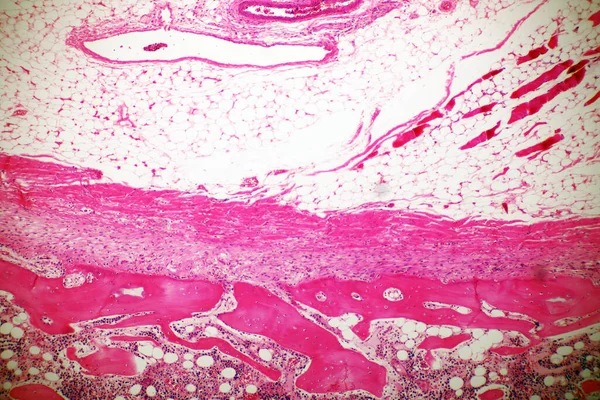 아데노이드 낭포성 마이크로 범위는 부위에 종류의 종양은 매크로 40X 미생물학 — 스톡 사진