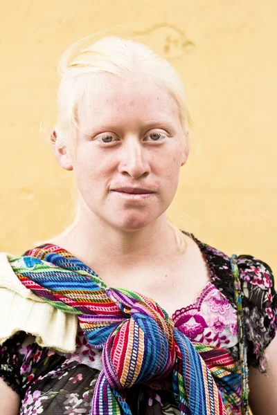 Femme albinos — Photo